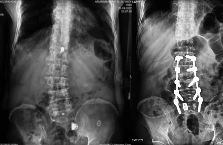 cost of spine surgery in india