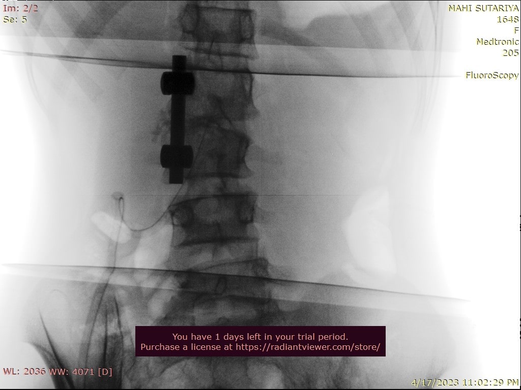 spine surgery x-ray