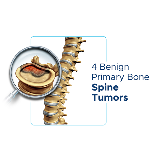 Benign Primary Bone Spine Tumors