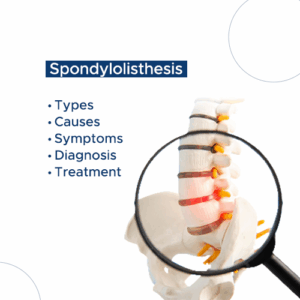 spondylolisthesis treatment
