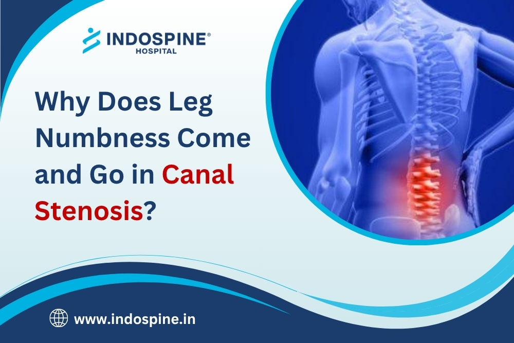 Leg Numbness Come and Go in Canal Stenosis