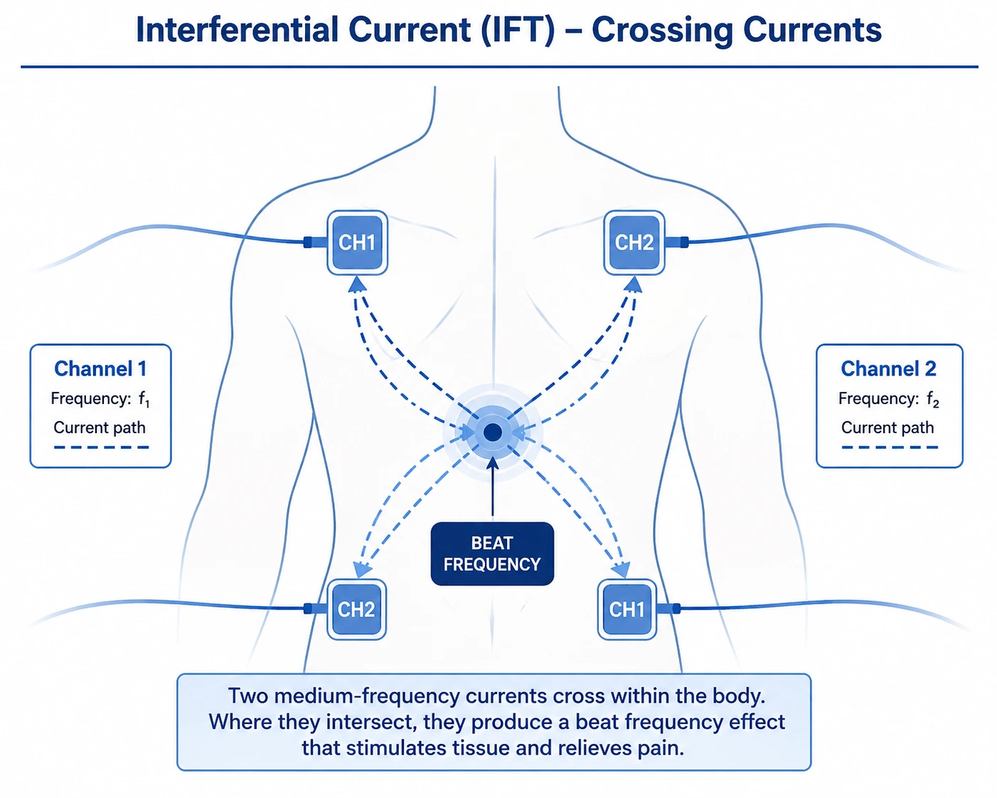 Diagram showing how interferential therapy IFT currents cross to relieve pain